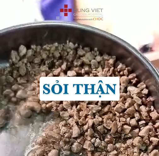 Tán sỏi thận