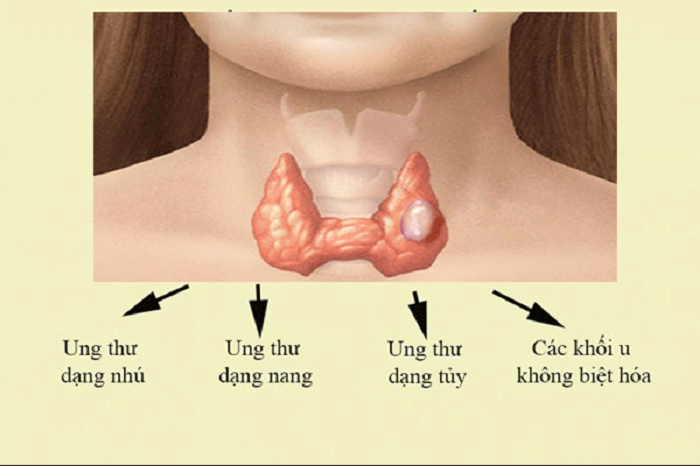 triệu chứng ung thư u tuyến giáp