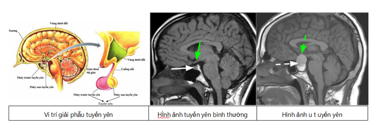 U tuyến yên và một số biểu hiện bất thường của cơ thể