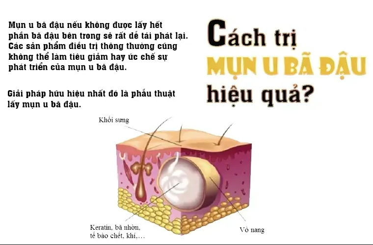 Cách trị u nang bã đậu