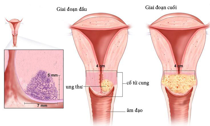 Ung thư buồng trứng