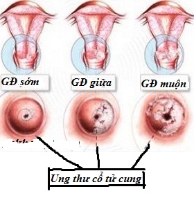 ung-thu-co-tu-cung-la-gi