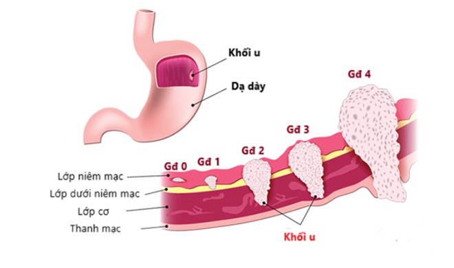 Ung thư dạ dày giai đoạn 2