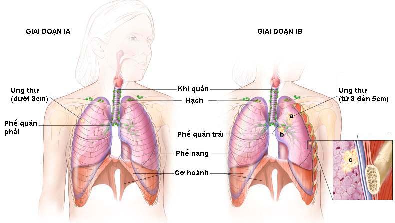 Phát hiện sớm ung thư phổi