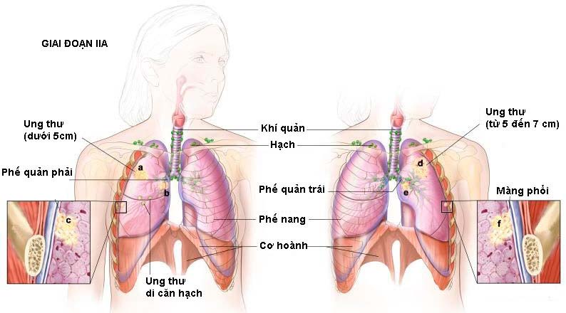 Dấu hiệu nhận biết ung thư phổi