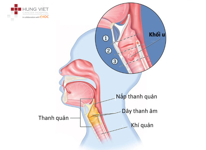 ung thư thanh quản