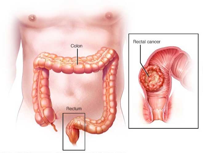 Ung thư trực tràng thấp là khối u đường tiêu hóa