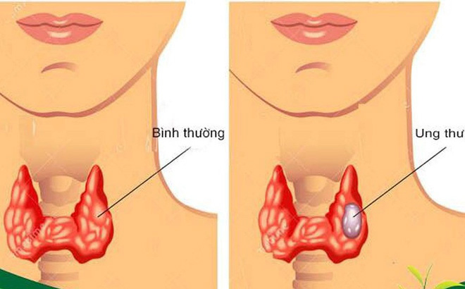 Ung thư tuyến giáp