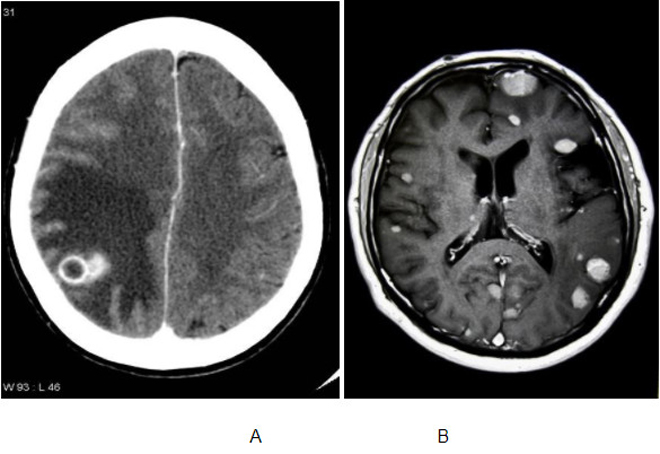 ung thư di căn não đơn ổ (A), và u di căn não đa ổ (B)