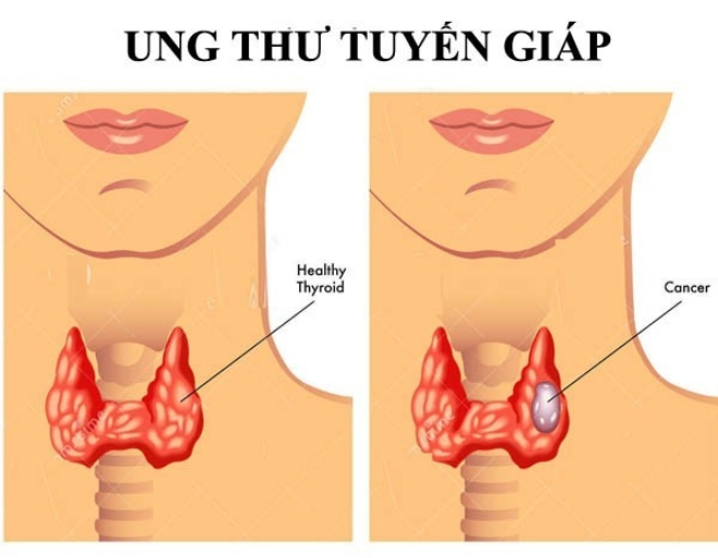 Ung thư tuyến giáp