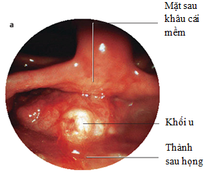 Dấu hiệu nhận biết ung thư vòm họng