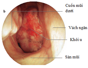 Dấu hiệu nhậ biết ung thư vòm họng Dấu hiệu nhậ biết ung thư vòm họng