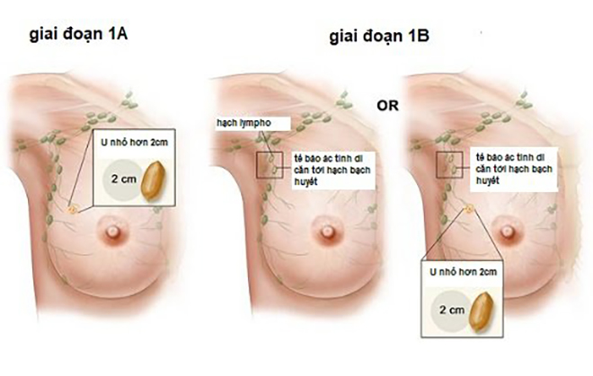 Ung thư vú giai đoạn 1
