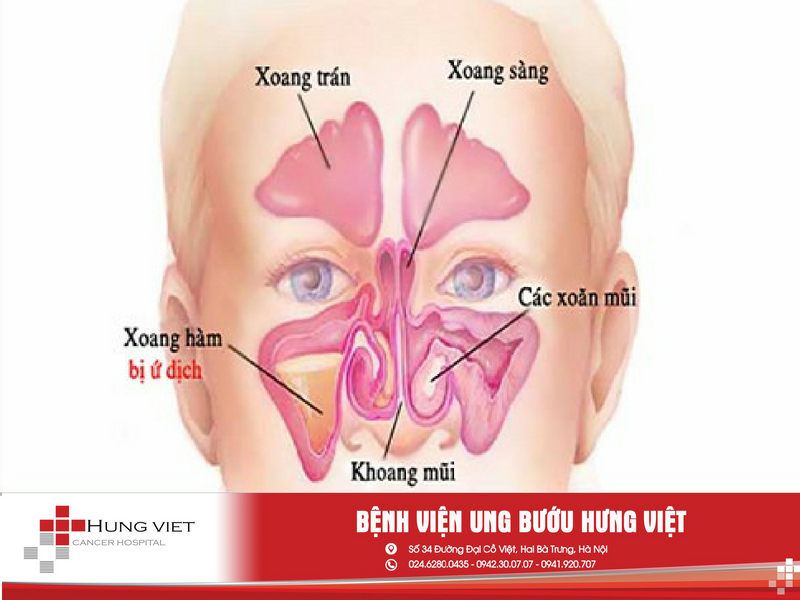 Phân biệt viêm xoang và viêm mũi dị ứng