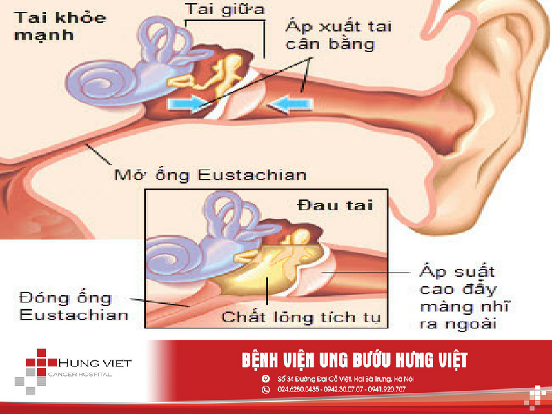 Viêm tai giữa Viêm tai giữa