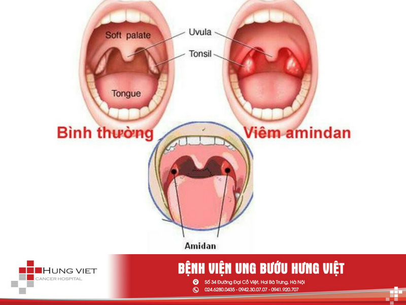 Viêm amidan