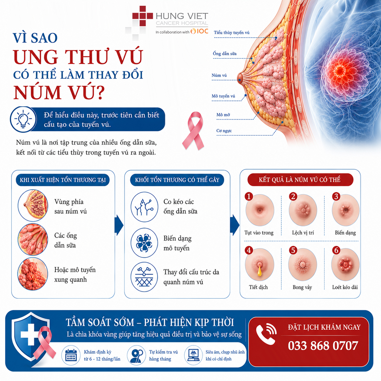 Vì sao ung thư vú có thể thay đổi núm vú