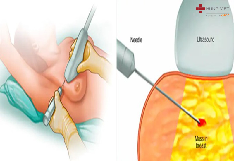 Xét nghiệm máu có phát hiện ung thư không