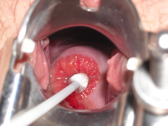 Chi phí xét nghiệm Pap smear